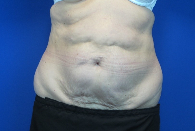 Before treatment: Tummy Tuck Surgery Waukesha