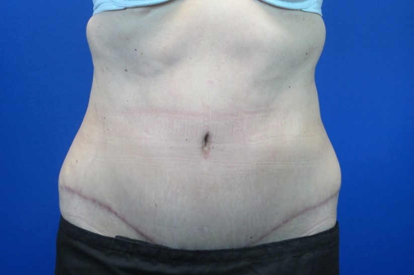 After treatment: Tummy Tuck Surgery Waukesha