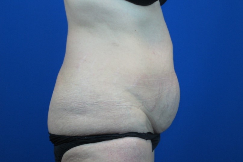 Before treatment: Tummy Tuck West Allis