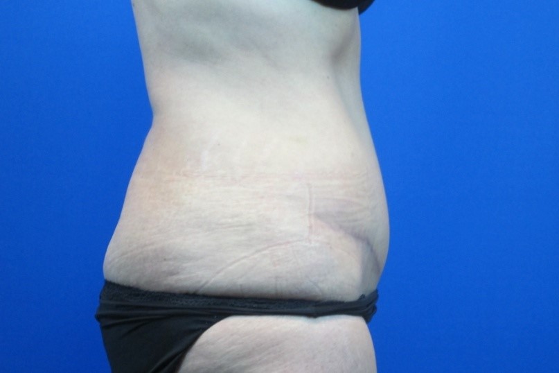 After treatment: Tummy Tuck West Allis