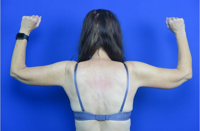 After treatment: Successful arm fat removal surgery in Brookfield