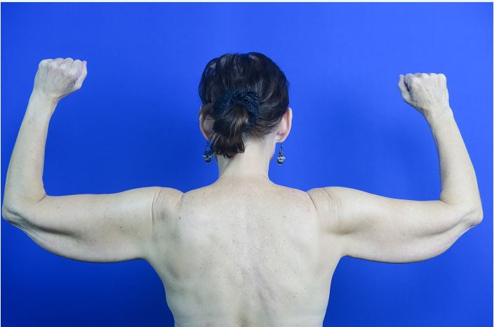Before treatment: Successful arm fat removal surgery in Brookfield