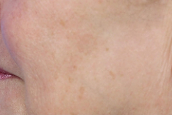Before treatment: Before and after BBL Laser - Pigment - 3 BBL BroadBand Light Treatments -  Waukesha WI