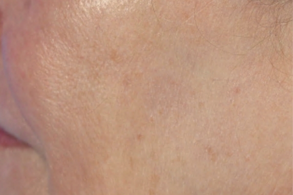 After treatment: Before and after BBL Laser - Pigment - 3 BBL BroadBand Light Treatments -  Waukesha WI