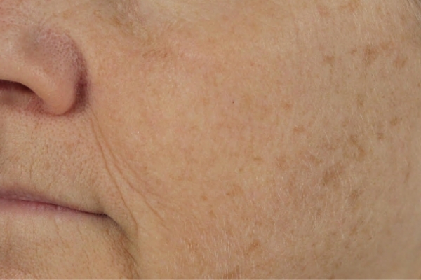 Before treatment: Before and after BBL Laser - Pigment - 3 BBL BroadBand Light Treatments -  Oconomowoc WI