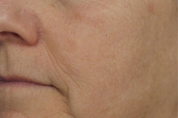 After treatment: Before and after BBL Laser - Pigment - 3 BBL BroadBand Light Treatments -  Oconomowoc WI
