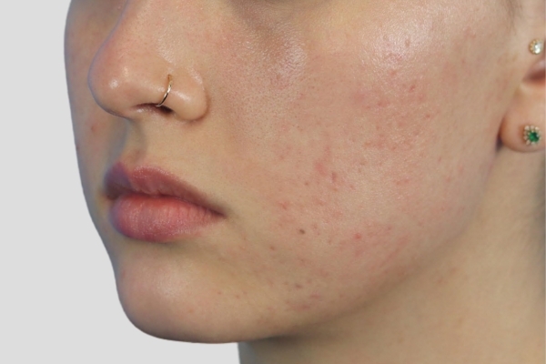 After treatment: Before and after BBL Laser - Forever Clear Acne Laser - 3 BBL BroadBand Light Treatments -  Brookfield WI