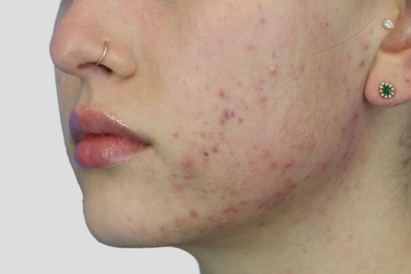Before treatment: Before and after BBL Laser - Forever Clear Acne Laser - 3 BBL BroadBand Light Treatments -  Brookfield WI