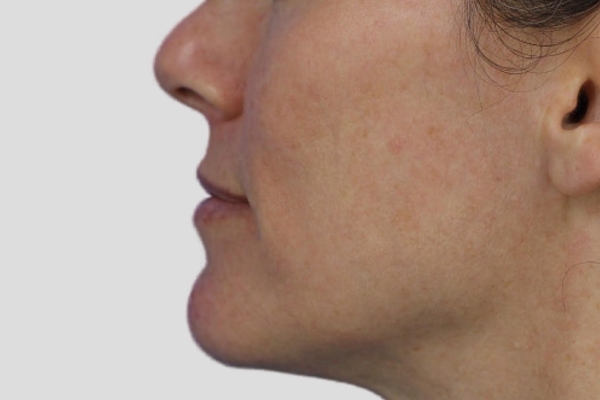 After treatment: Before and after BBL MOXI - Hyperpigmentation - 3 BBL MOXI Laser Treatments -  Waukesha WI