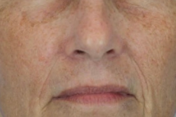 Before treatment: Before and after BBL MOXI - Hyperpigmentation - 3 BBL MOXI Laser Treatments -  Oconomowoc WI