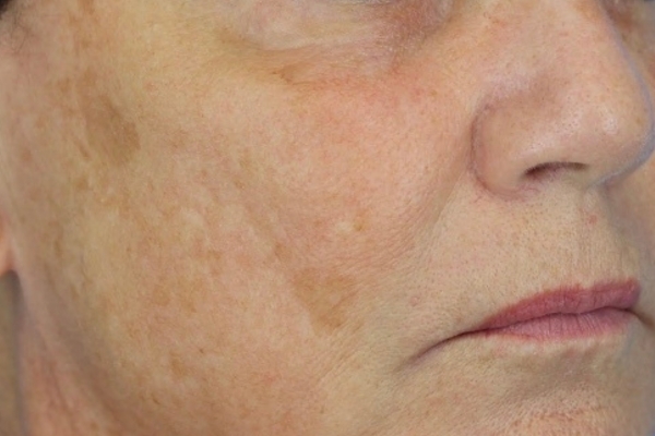 Before treatment: Before and after BBL MOXI - Hyperpigmentation - 3 BBL MOXI Laser Treatments -  Elm GroveWI
