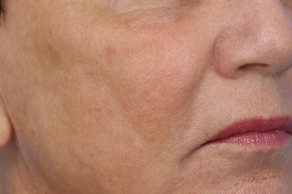 After treatment: Before and after BBL MOXI - Hyperpigmentation - 3 BBL MOXI Laser Treatments -  Elm GroveWI