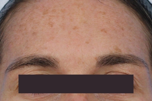 Before treatment: Before and after BBL MOXI - Hyperpigmentation - 3 BBL MOXI Laser Treatments -  Pewaukee  WI