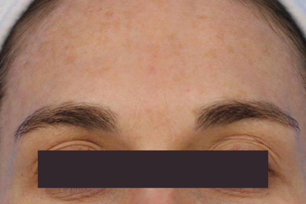 After treatment: Before and after BBL MOXI - Hyperpigmentation - 3 BBL MOXI Laser Treatments -  Pewaukee  WI