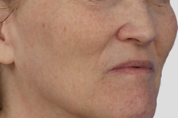 Before treatment: Before and after BBL MOXI - Hyperpigmentation - 3 BBL MOXI Laser Treatments -  Delafield WI
