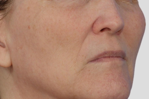 After treatment: Before and after BBL MOXI - Hyperpigmentation - 3 BBL MOXI Laser Treatments -  Delafield WI