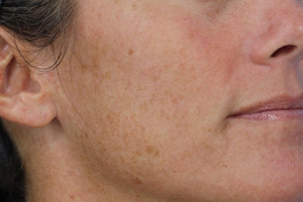 Before treatment: Before and after BBL MOXI - Hyperpigmentation - 3 BBL MOXI Laser Treatments -  Brookfield WI