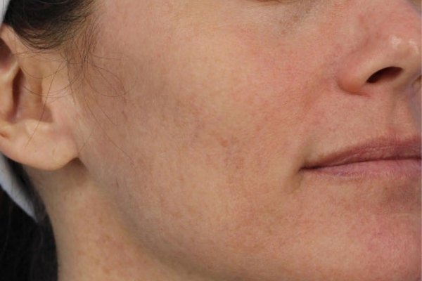 After treatment: Before and after BBL MOXI - Hyperpigmentation - 3 BBL MOXI Laser Treatments -  Brookfield WI
