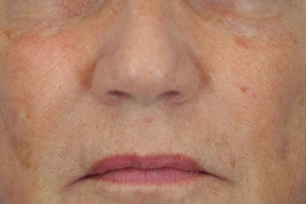 Before treatment: Before and after BBL MOXI - Hyperpigmentation - 3 BBL MOXI Laser Treatments -  Wauwatosa WI