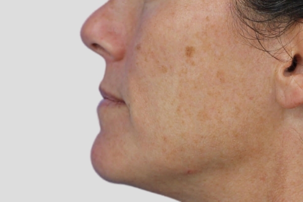 Before treatment: Before and after BBL MOXI - Hyperpigmentation - 3 BBL MOXI Laser Treatments -  Waukesha WI