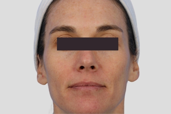 After treatment: Before and after BBL MOXI - Skin Tone Texture - 3 BBL MOXI Laser Treatments -  Brookfield WI
