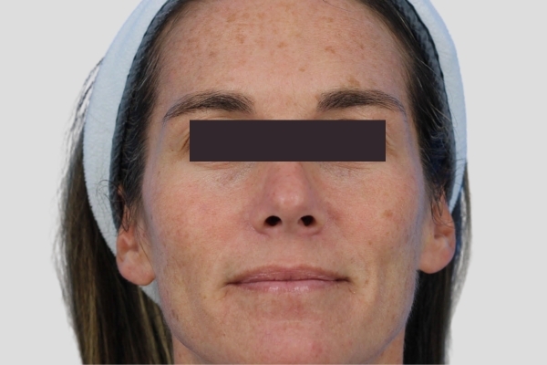 Before treatment: Before and after BBL MOXI - Skin Tone Texture - 3 BBL MOXI Laser Treatments -  Brookfield WI
