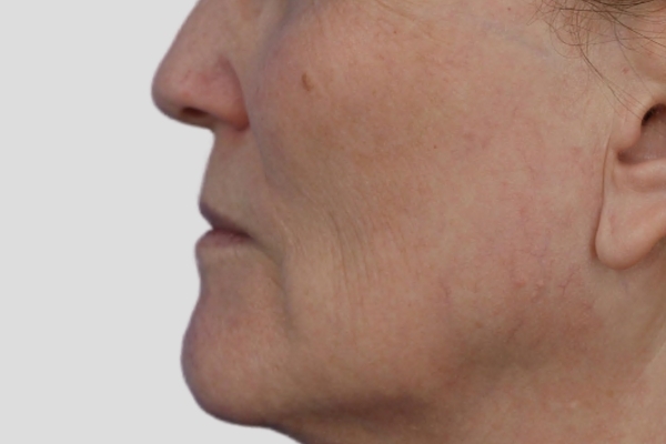 After treatment: Before and after BBL MOXI - Skin Tone Texture - 3 BBL MOXI Laser Treatments -  Pewaukee WI