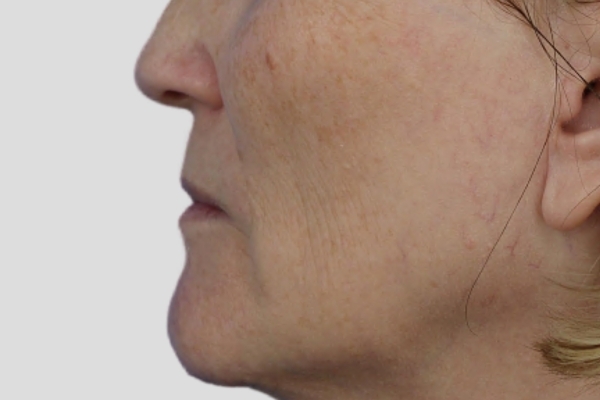 Before treatment: Before and after BBL MOXI - Skin Tone Texture - 3 BBL MOXI Laser Treatments -  Pewaukee WI