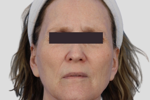 After treatment: Before and after BBL MOXI - Skin Tone Texture - 3 BBL MOXI Laser Treatments -  Waukesha WI