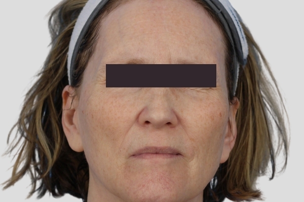Before treatment: Before and after BBL MOXI - Skin Tone Texture - 3 BBL MOXI Laser Treatments -  Waukesha WI