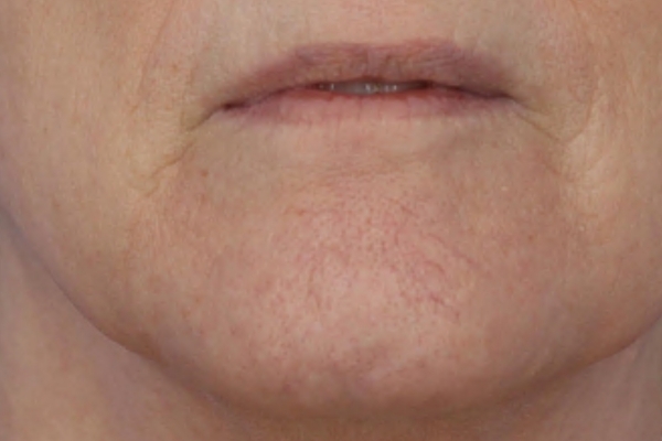 After treatment: Before and after BBL MOXI - Spider Veins Telangiectasias - 3 BBL MOXI Laser Treatments -  Brookfield WI