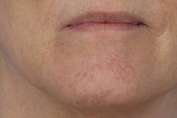 Before treatment: Before and after BBL MOXI - Spider Veins Telangiectasias - 3 BBL MOXI Laser Treatments -  Brookfield WI