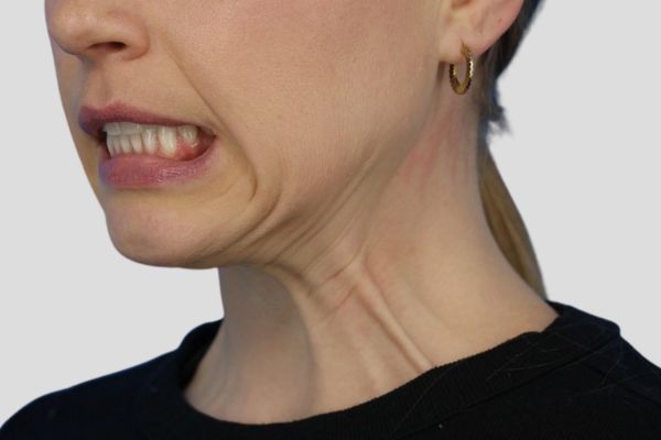 Before treatment: Before and After Botox - Female - Platysma Bands Neck - Milwaukee, WI