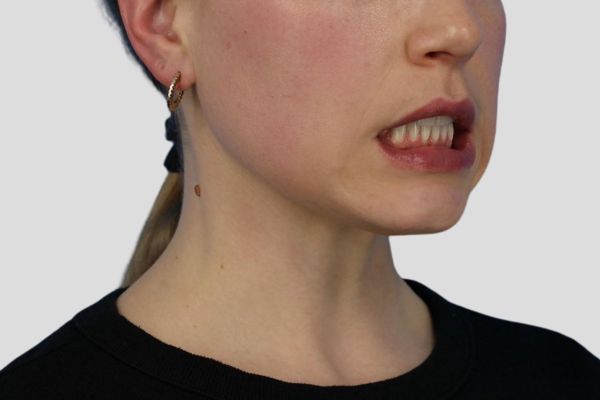 After treatment: Before and After Botox - Female - Platysma Bands Neck - Waukesha, WI