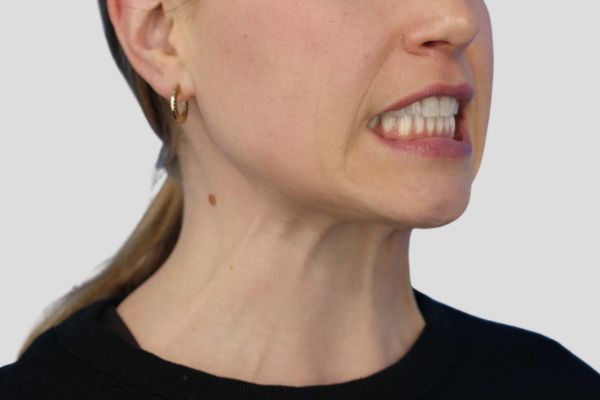 Before treatment: Before and After Botox - Female - Platysma Bands Neck - Waukesha, WI