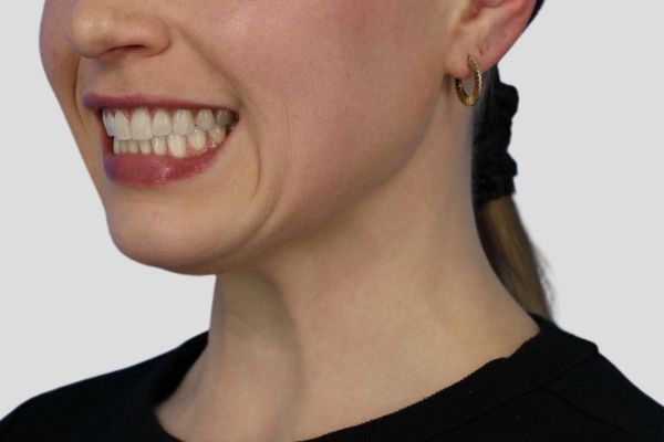After treatment: Before and After Botox - Female - Platysma Bands Neck - Milwaukee, WI