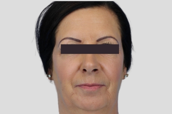 After treatment: Before and After Botox Fillers - Full Face Injectables - Wauwatosa, WI