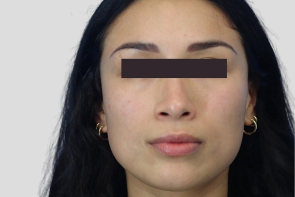 Before treatment: Before and After Botox Fillers - Full Face Injectables - Brookfield, WI