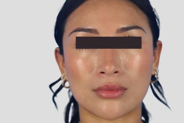 After treatment: Before and After Botox Fillers - Full Face Injectables - Brookfield, WI