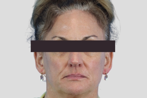 Before treatment: Before and After Botox Fillers - Full Face Injectables - Waukesha, WI