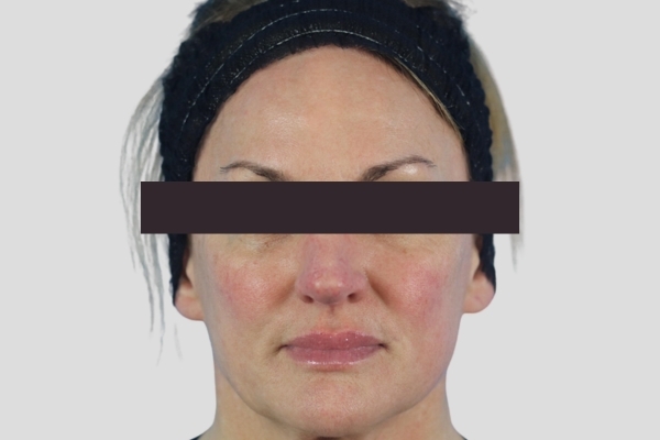After treatment: Before and After Botox Fillers - Full Face Injectables - Waukesha, WI