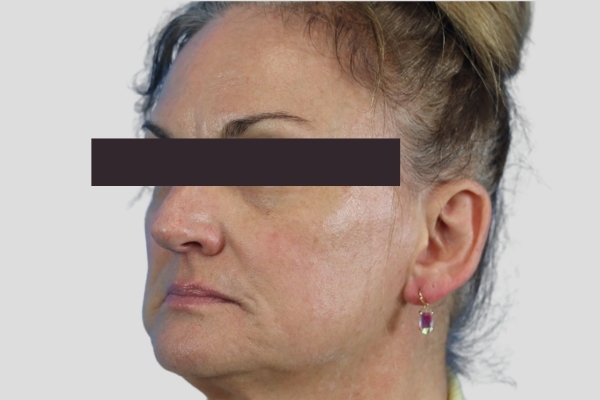 Before treatment: Before and After Botox Fillers - Full Face Injectables - Pewaukee, WI