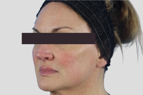 After treatment: Before and After Botox Fillers - Full Face Injectables - Pewaukee, WI