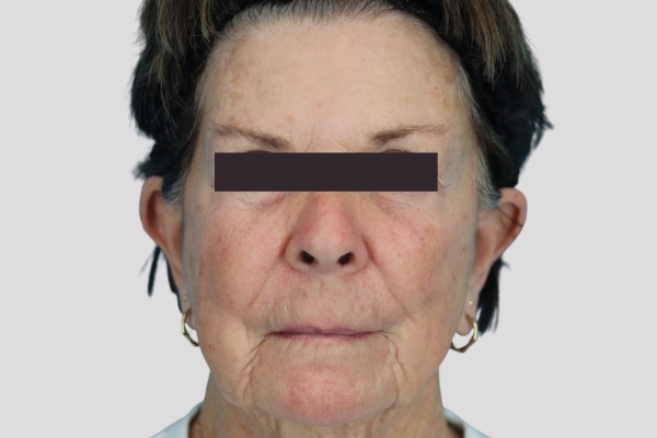 Before treatment: Before and After Botox Fillers - Full Face Injectables - Milwaukee, WI