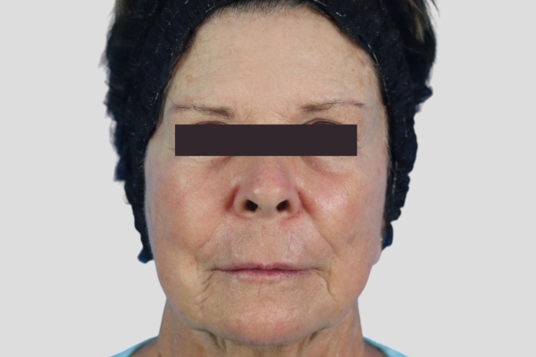 After treatment: Before and After Botox Fillers - Full Face Injectables - Milwaukee, WI