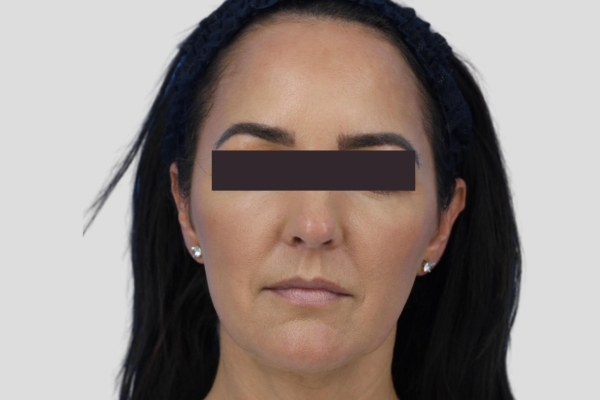Before treatment: Before and After Botox Fillers - Full Face Injectables - Greenfield, WI