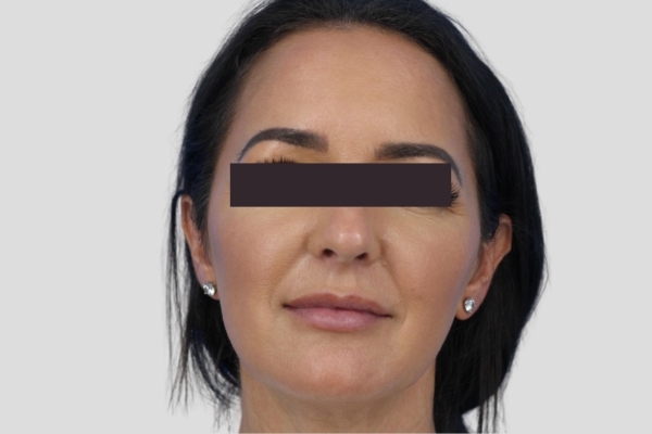 After treatment: Before and After Botox Fillers - Full Face Injectables - Greenfield, WI