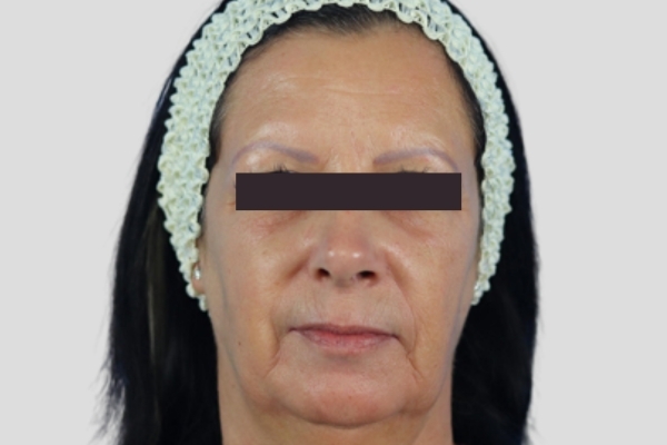 Before treatment: Before and After Botox Fillers - Full Face Injectables - Wauwatosa, WI