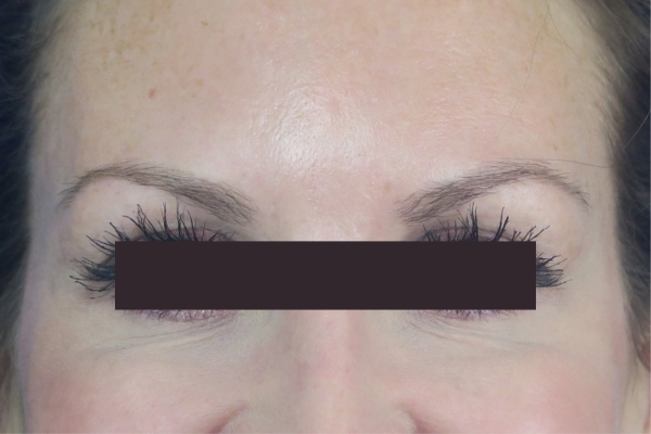 After treatment: Before and After Botox - Female - Crows Feet - Brookfield, WI