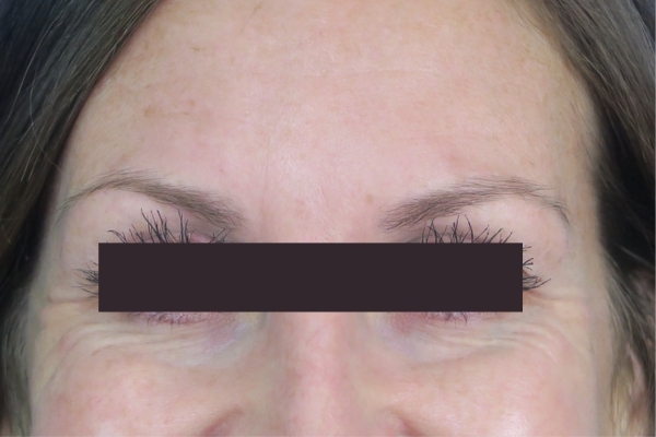 Before treatment: Before and After Botox - Female - Crows Feet - Brookfield, WI